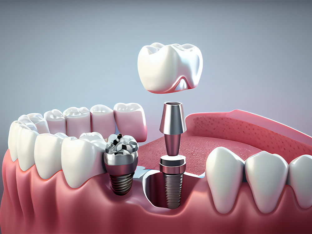 Dental Implants in Tirupati: Why Getting Treatment at the Right Time Matters Most