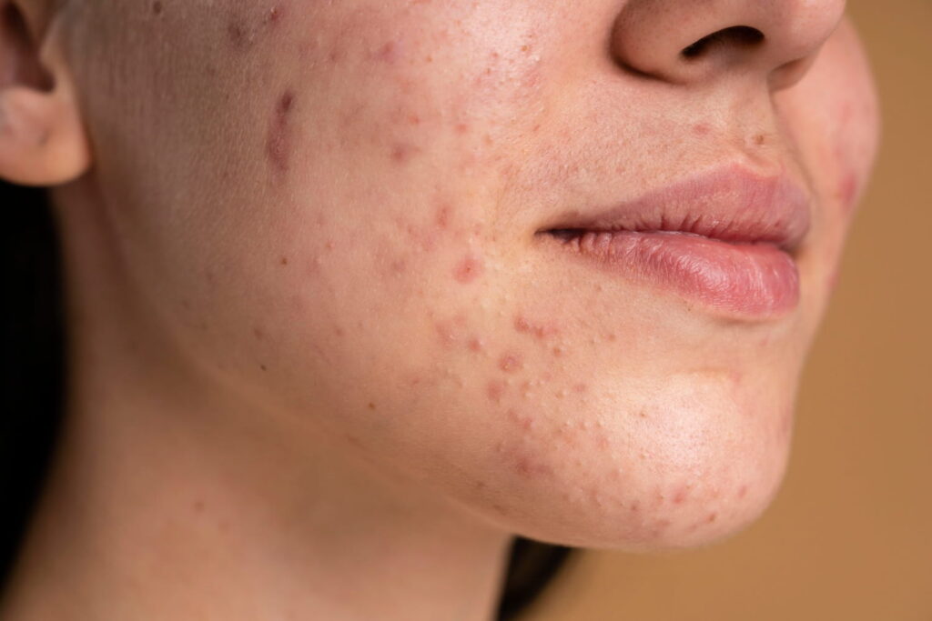 Types of Acne Scars and Their Treatment Options in Jayanagar