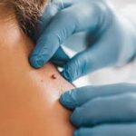 Moles Removal in Dubai for Safe and Effective Skin Treatment