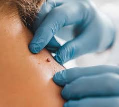 Moles Removal in Dubai for Safe and Effective Skin Treatment