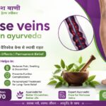 How Does Varicose Veins Treatment in Ayurveda Improve Blood Circulation?
