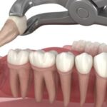 Common Symptoms of Impacted Wisdom Teeth