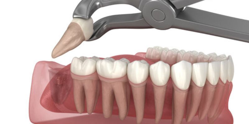 Common Symptoms of Impacted Wisdom Teeth