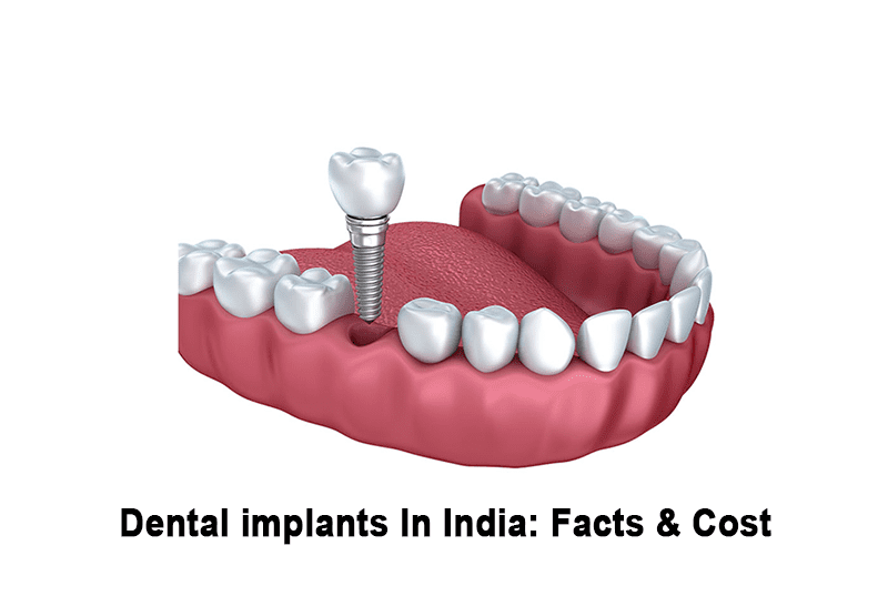 Cost to Get All-on-4 Dental Implants in India: What You Need to Know Before Deciding
