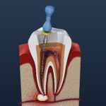 10 Warning Signs You May Need Root Canal Treatment Before It’s Too Late