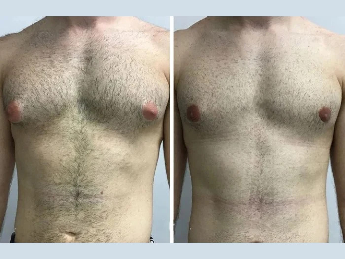 Gynecomastia in Dubai: Lifestyle Habits That Support Better Recovery Outcomes