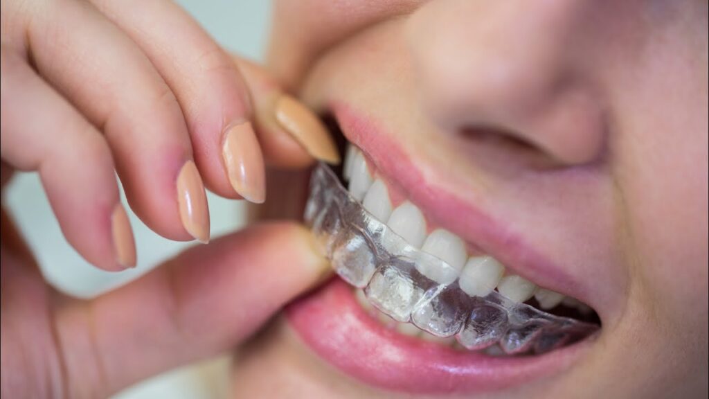 Why Working Professionals in Badlapur Prefer Clear Smile Correction for Straighter Teeth