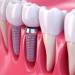 Why Visiting a Dental Implant Specialist in Bhandara Sooner Makes a Big Difference