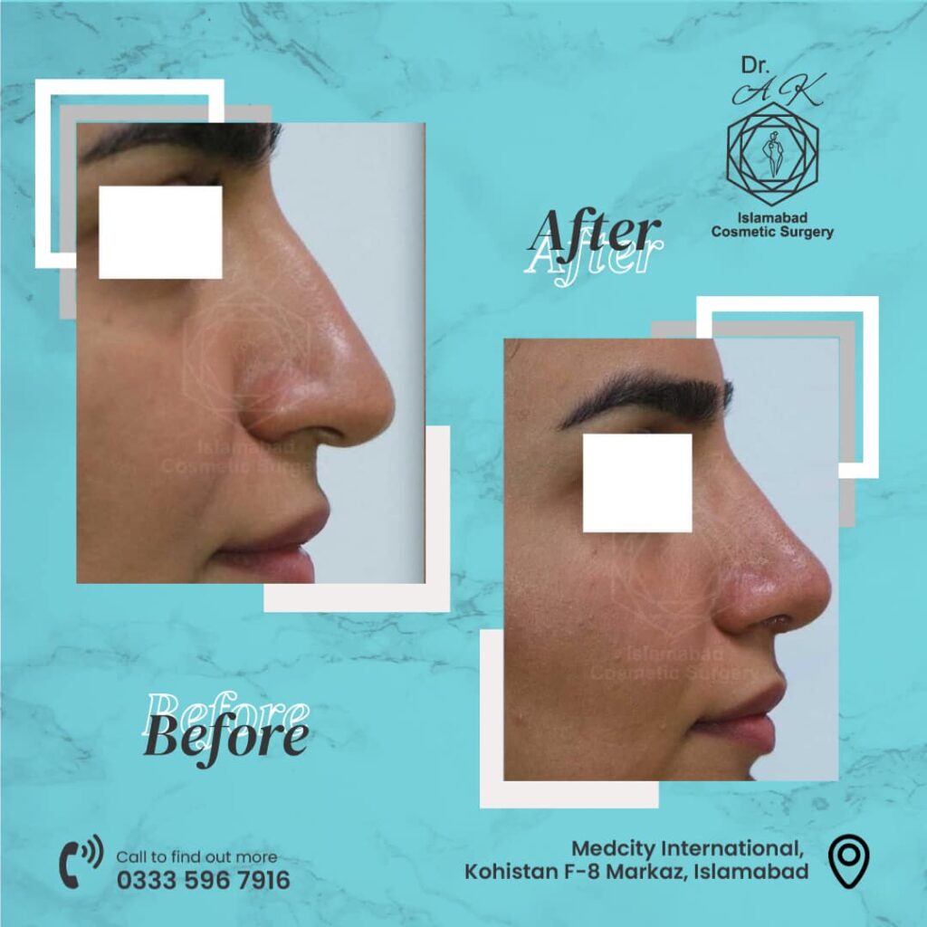 When Should You Consider Rhinoplasty Islamabad?