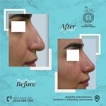 When Should You Consider Rhinoplasty Islamabad?