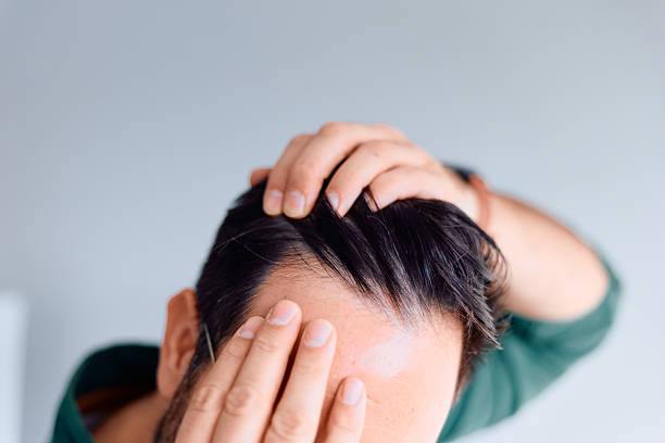 How Innovative Exosome Treatments Are Changing Hair Loss Solutions