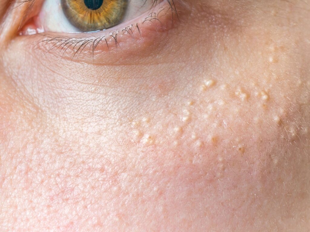 How Does Milia Treatment Support Healthy-Looking Skin?