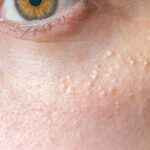 How Does Milia Treatment Support Healthy-Looking Skin?