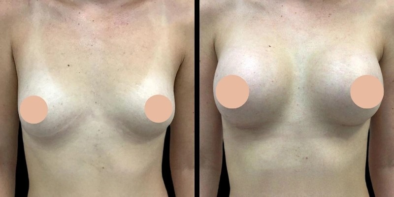 Why Patients Trust the Best Breast Augmentation Surgeon in Dubai for Customized Care