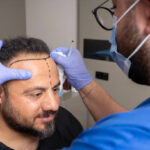 Common Questions About 5000 Grafts Hair Transplant Answered