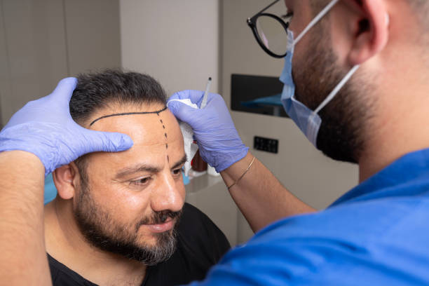 Common Questions About 5000 Grafts Hair Transplant Answered