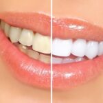 What Are the Teeth Whitening Options Available?