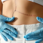Tummy Tuck Surgery in Dubai: Expert Solutions for Sagging
