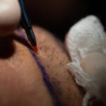 Average Cost of 5000 Grafts Hair Transplant in Riyadh
