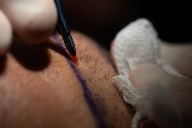 Average Cost of 5000 Grafts Hair Transplant in Riyadh