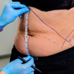 Top Plastic Surgery Procedures Offered at Tampa Palms Plastic Surgery