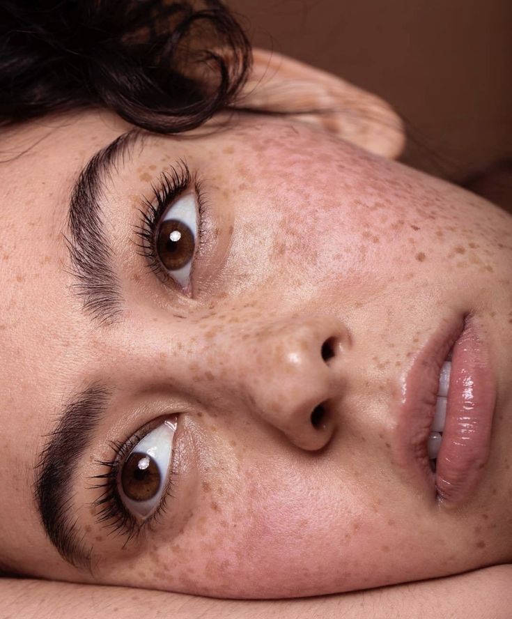 Why Is Freckles and Blemishes Treatment So Popular?
