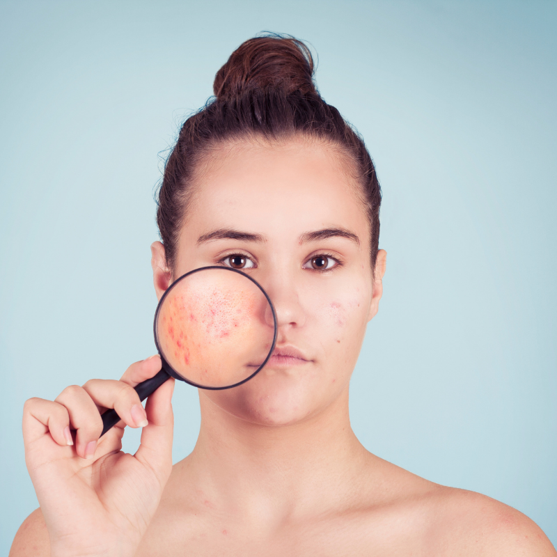 Is Tretiva 40 effective for treating acne scars and preventing new breakouts?