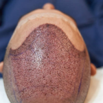 Hair Transplant in Riyadh: A Practical Path to Renewed Appearance