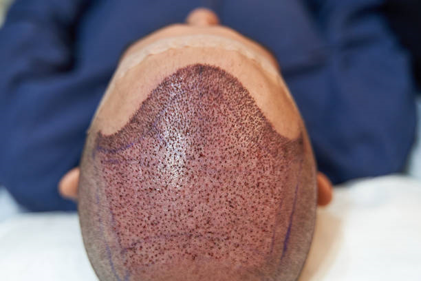 Hair Transplant in Riyadh: A Practical Path to Renewed Appearance