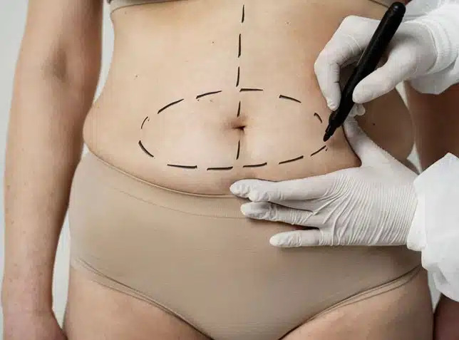 Post-Pregnancy Body Transformation with a Tummy Tuck in Dubai