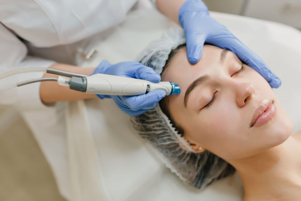 Acne Scar Treatment: How Microneedling Can Improve Your Skin