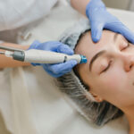 Acne Scar Treatment: How Microneedling Can Improve Your Skin