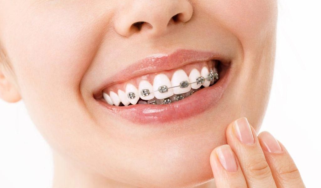 Braces Treatment in Zirakpur: A Complete Guide for First-Time Patients