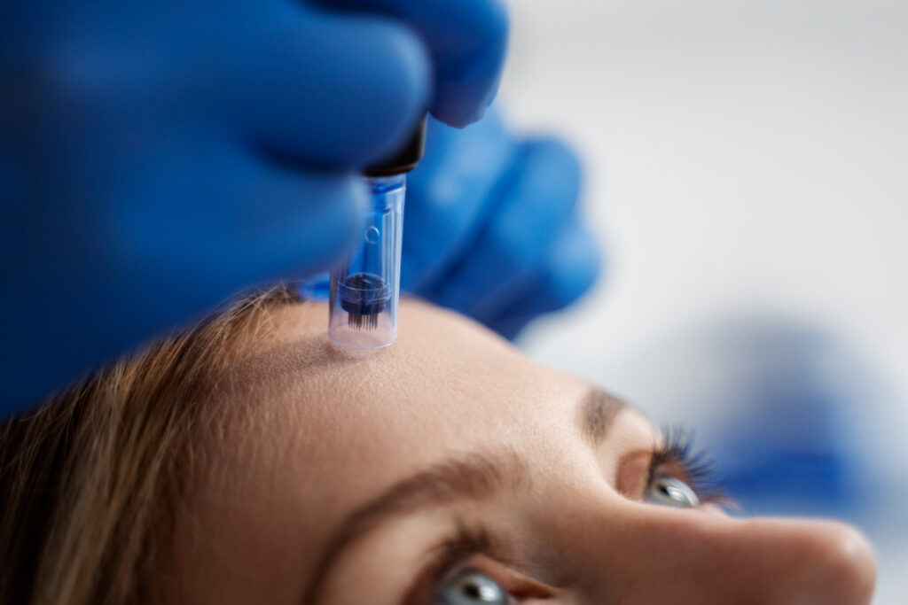 The Long-Term Effects of Skinpen Microneedling in Altrincham: What Studies Show