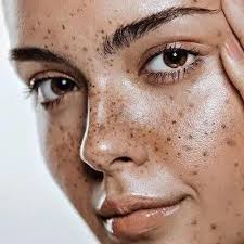 Pigmentation Treatment in Dubai: Modern Skin Brightening Solutions