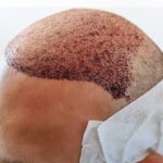 Hair Transplant in Dubai – Advanced Hair Restoration