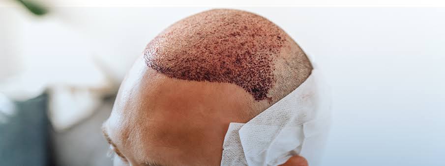 Hair Transplant in Dubai – Advanced Hair Restoration