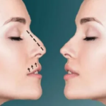 Rhinoplasty in Dubai: Transforming Form and Function