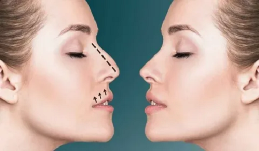 Rhinoplasty in Dubai: Transforming Form and Function