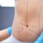Key Benefits of Choosing Lipo Abdominoplasty in Riyadh
