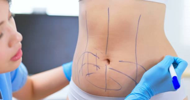 Key Benefits of Choosing Lipo Abdominoplasty in Riyadh