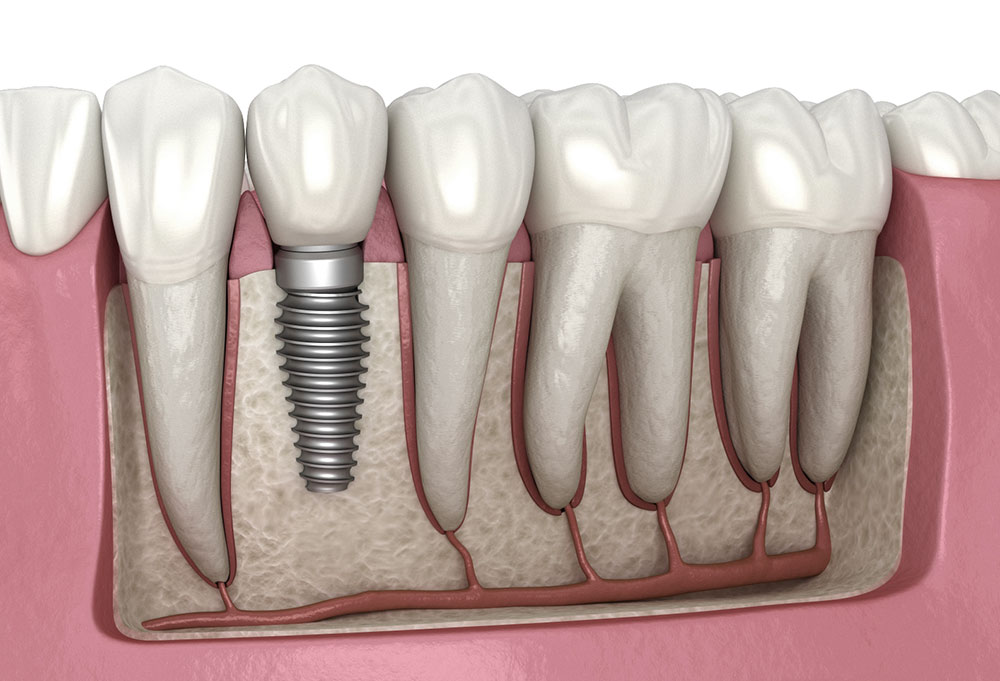 What Factors Influence Dental Implant Cost?