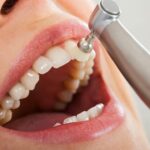 Teeth Cleaning and Scaling in Navi Mumbai: Understanding the Difference Between Routine Cleaning and Deep Scaling