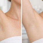 Laser Hair Removal: Achieve Smooth, Hair-Free Skin with Lasting Results