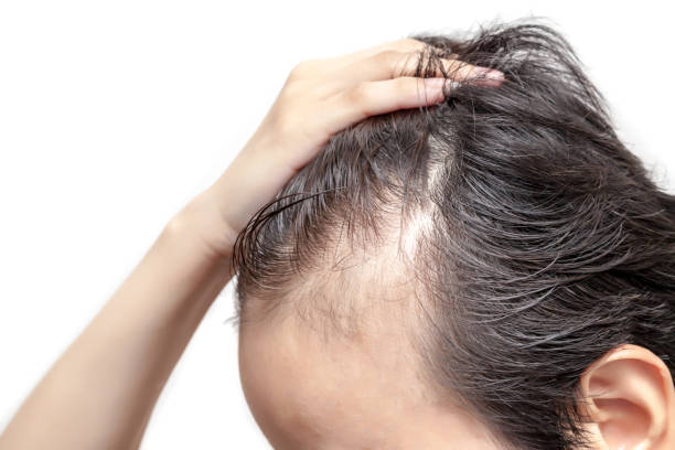 Combining Hair Loss Treatment with Scalp Care
