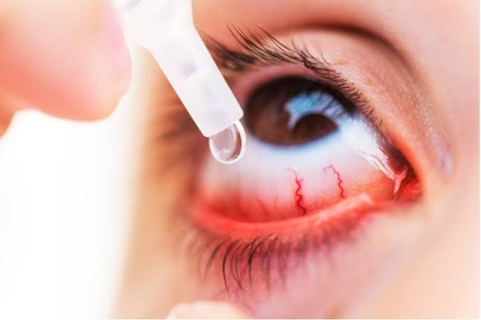 Breathe Easier with Expert Care for Persistent Eye Allergies
