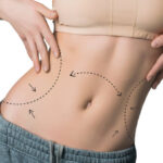 How the Right Liposuction Surgeon Helps Achieve Your Desired Shape