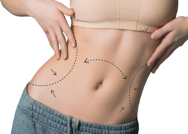 How the Right Liposuction Surgeon Helps Achieve Your Desired Shape