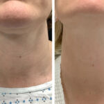 Why Patients Prefer Best Plastic Surgeons in Dubai Radiofrequency (RF) Microneedling
