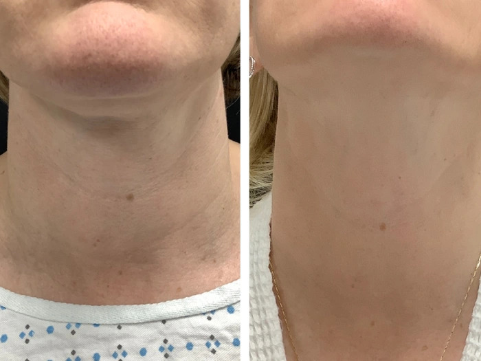Why Patients Prefer Best Plastic Surgeons in Dubai Radiofrequency (RF) Microneedling
